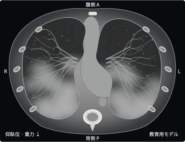 アプリの模式CT画面。左右の肺を断面図で示し、モデル内の含気の違いを濃淡で表示する。